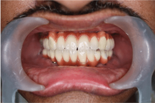 Implants Example