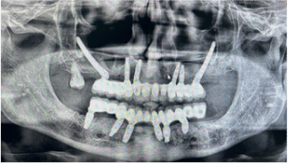 Implants