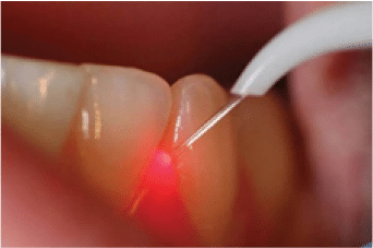 Advanced Lasers