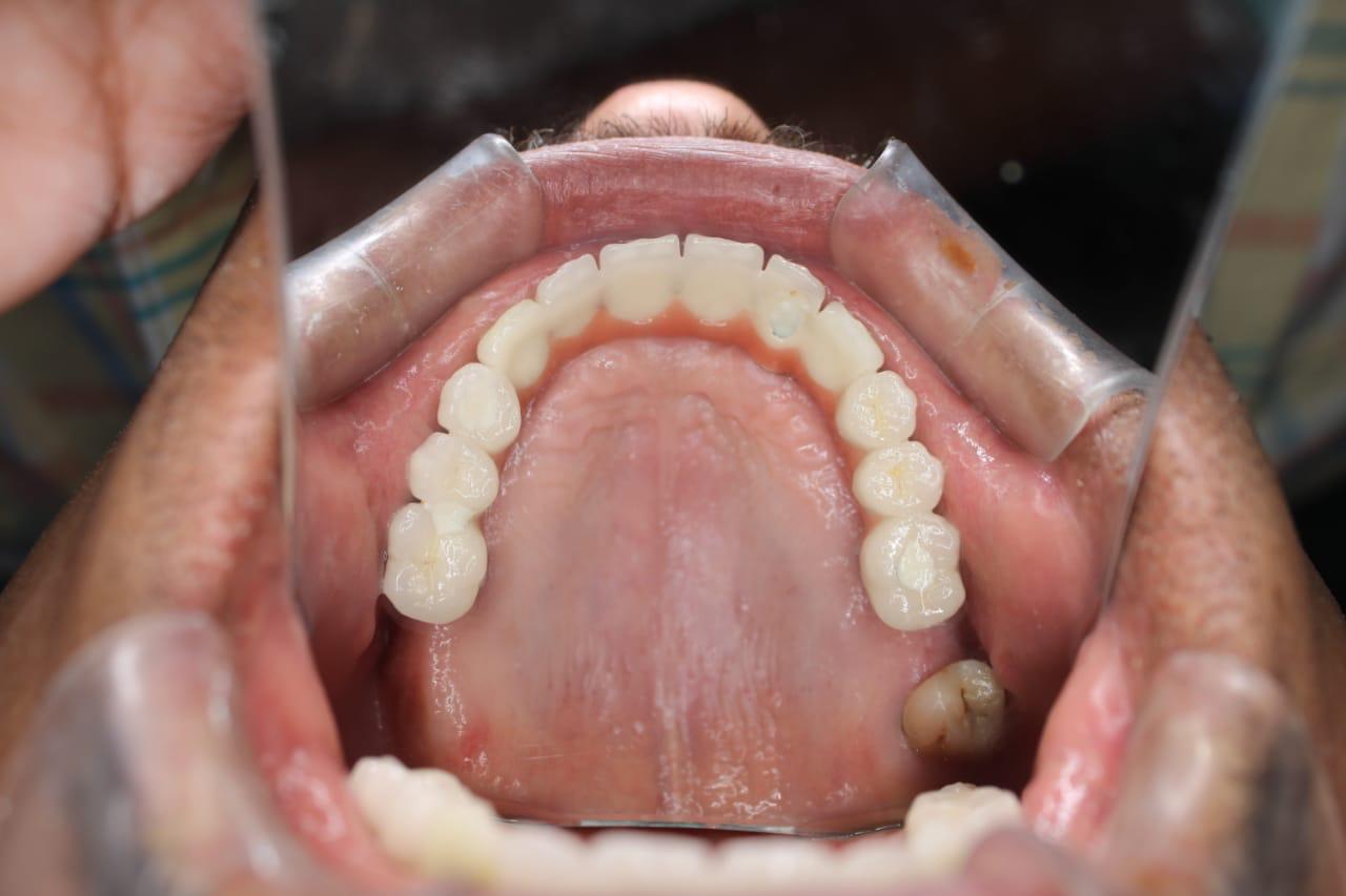 Implants Example