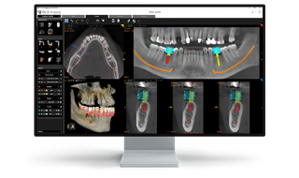 Invisalign Aligners