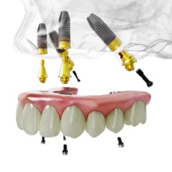 Implants Example