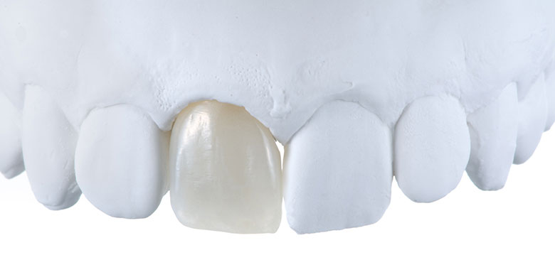 Implants Example
