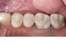 After Implants